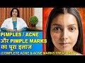 Pimples/Acne और Pimple Marks का पूरा इलाज || Complete Treatment of Acne & Acne Marks