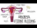 Abnormal Uterine Bleeding (AUB) - Menorrhagia & Heavy Menstrual Bleeding | (Including Mnemonic!)