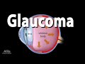 Development of Glaucoma Animation, Open Angle vs Angle Closure Glaucoma.
