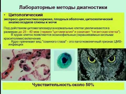 Цитомегаловирусная инфекция что это как лечить Цитомегаловирусная инфекция что это как лечить