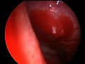 L Septal Bleeding 5  WITH GROWTH