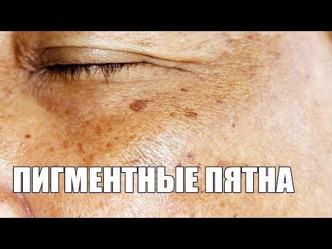 Быстро отбелить пигментное пятно в домашних условиях Быстро отбелить пигментное пятно в домашних условиях