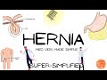 Inguinal hernia (embryology, types, clinical features, examination, surgeries) | Surgery SIMPLIFIED