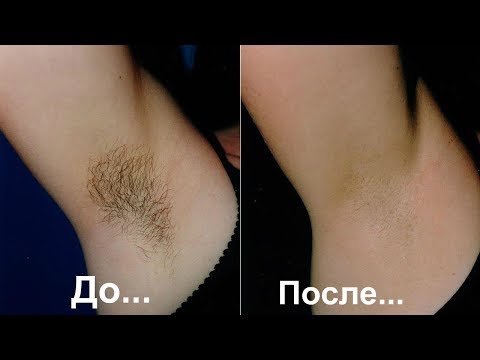 Удалить волосы в подмышках навсегда в домашних условиях Удалить волосы в подмышках навсегда в домашних условиях