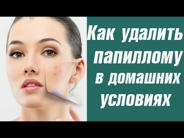 Как удалить папиллому в домашних условиях на веках Как удалить папиллому в домашних условиях на веках