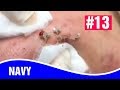 AMAZING! Blackheads Removal How To Remove Blackheads , NAVY #13
