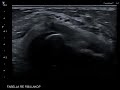 Nerve ultrasound case - fibular (peroneal) nerve entrapment and a fabella