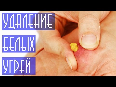 Как вытянуть гной из прыща Как вытянуть гной из прыща Женский журнал