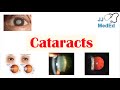 Cataracts | Causes, Risk factors, Subtypes (Cortical, Nuclear, Posterior subcapsular), Treatment