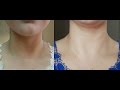 How to Get Rid of Dark Neck in 20 Minutes