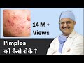 Pimples को कैसे रोके (How to Prevent Pimples) | 2023 | ClearSkin, Pune | (In HINDI)