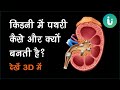 किडनी में पथरी कैसे बनती है और इसे कैसे निकालें - देखें 3D में - Kidney stone treatment in Hindi