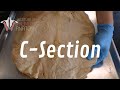 The Anatomy of a C-Section