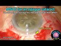 CataractCoach™ 2180: MSICS opaque cataract