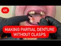 MAKING PARTIAL DENTURE WITHOUT CLASPS- ALL STEPS AND INSERTION 4K #waxbae
