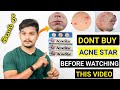 Dont Buy Acne Star Cream Before Watching This Video | Telugu | Will Acne Star Removes Pimples ?