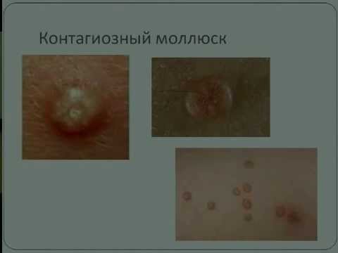dlya zhenshin profilaktika papillomavirus odin Папилломавирус профилактика для женщин фото