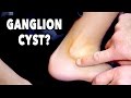 GANGLION CYST? | Dr. Paul