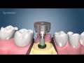 Dental Implant Procedure - Two Stage  🦷  Award Winning Patient Education