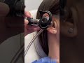 How an ENT Doctor Removes Ear Wax