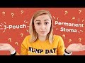 Permanent Stoma or J Pouch Surgery? | Hannah Witton