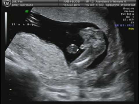 20 Week Ultrasound Boy Pregnancy Diet