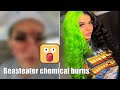 Beasteater chemical burns : TikTok star BeastEater confirms infection chemical burn on face