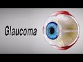 Glaucoma (Animation of Why It Happens and How It Can Cause Blindness)