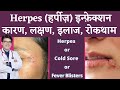 Herpes Infection Of Skin | हर्पीज़ के कारण, लक्षण, इलाज | Herpes Symptoms, Causes, Treatment | Hindi
