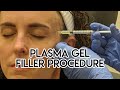 Plasma Gel Filler Procedure