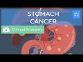 Stomach cancer: Definition, causes, symptoms and treatment | Kenhub