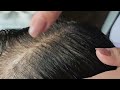 100% assured, natural, permanent n painless hair regrowth process.. INDIA'S no. 1..