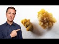 The Deeper Cause of Kidney Stones You've Never Heard About