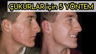 Sivilce İzleri ( Çukurları ) Geçirmenin 5 Yolu !