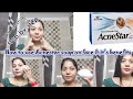 How to use Acnestar soap on face/Acnestar benefits/Pimple & acne treatment/Acneprone skin skincare