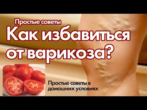 Как избавится от варикозы в домашних условиях