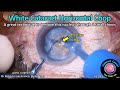 CataractCoach™ 2181: white cataract horizontal chop