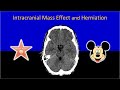 Imaging of Intracranial Mass Effect and Brain Herniation Made Easy