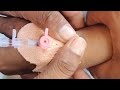 Cannulation.. video.. part.. 143