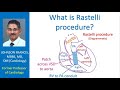 What is Rastelli procedure?