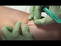 Removing a One Rod Implant, Teaching Short (HWs), French - Family Planning Series