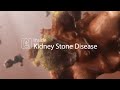 Medical Animation: Kidney Stone Disease