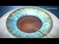Cataract Surgery Animation