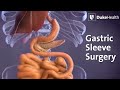 Gastric Sleeve Surgery | Duke Health