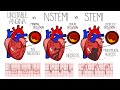 Acute Coronary Syndrome (Heart Attack) - Unstable Angina vs NSTEMI vs STEMI | With ECGs