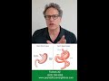 Gastric Sleeve vs. Gastric Bypass, what's the difference 2023