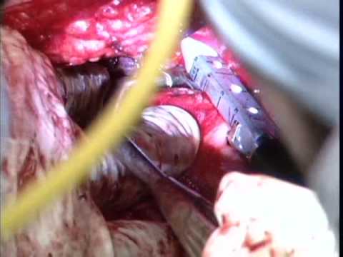 Extrapleural Pneumonectomy for Mesothelioma
