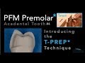 PFM Premolar Using T-PREP Technique - Acadental Tooth #4