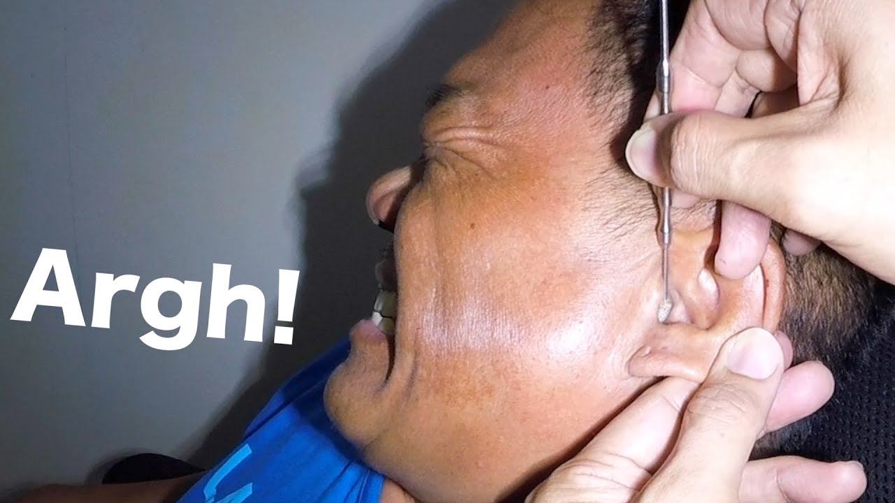 Something HARD Stuck in Man’s Ear | Is it A Wax or Not?