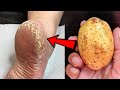 Eliminate Cracked Heels and get White and Smooth Feet / Magic Cracked Heels home remedy